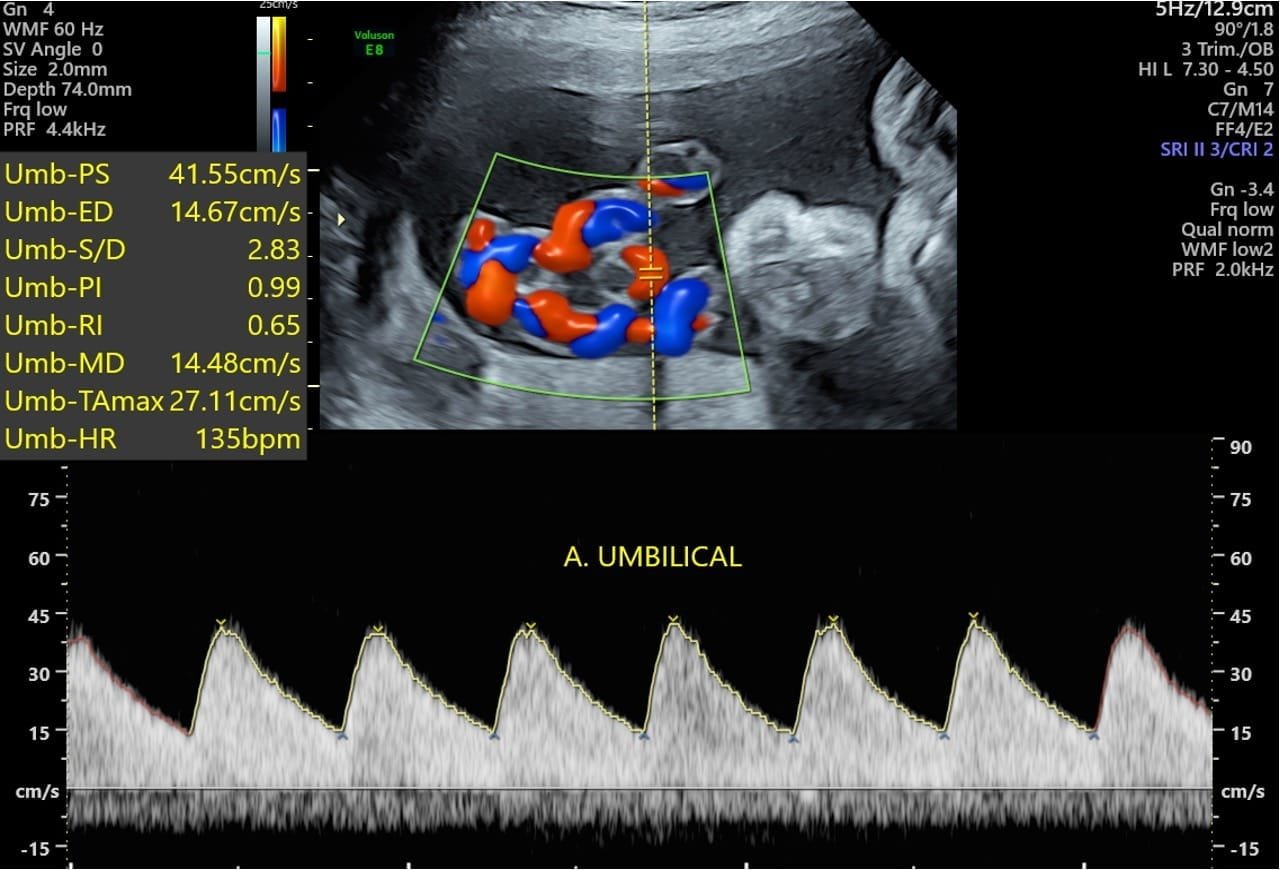 Artéria Umbilical